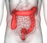 שלשול דמי - תמונת אווירה